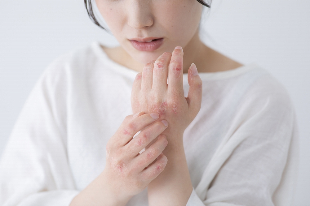 湿疹について