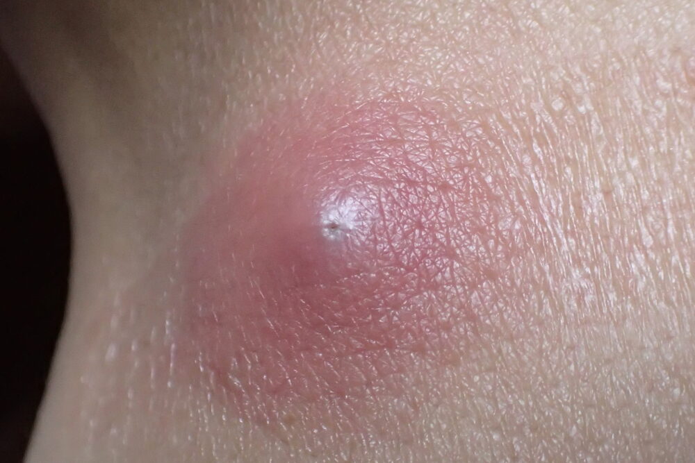 皮膚腫瘍