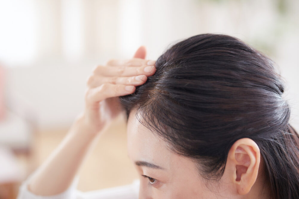 女性型脱毛症について